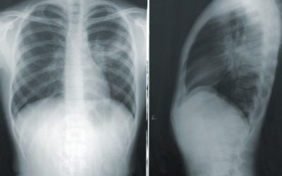Meringankan Gejala Bronkitis Secara Alami